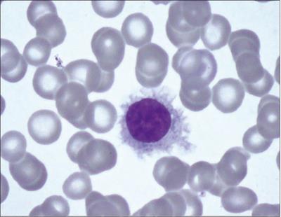 Case report: A case of classic hairy cell leukemia with CNS involvement treated with vemurafenib